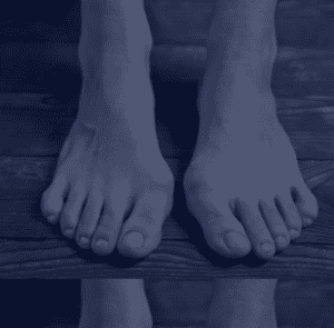 Lapiplasty 3D bunion correction surgery for severe bunion deformities