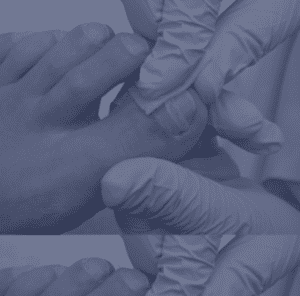 Ingrown toenail condition with nail growing into the surrounding skin