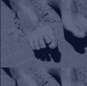 Hammertoe deformity showing bent or curled toes of the foot