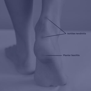Regenerative medicine treatment options for foot and ankle conditions