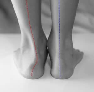 Weak ankles and ankle instability requiring podiatric treatment