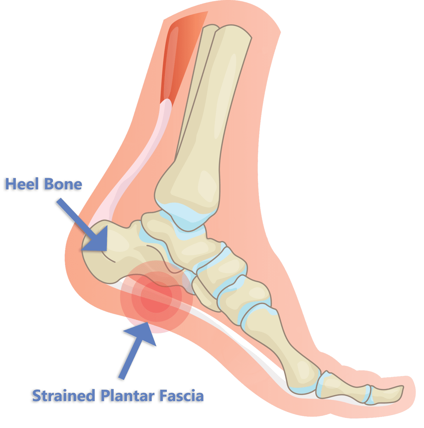 Plantar Fasciitis - Heel Pain Explained - Optimum Foot Clinic