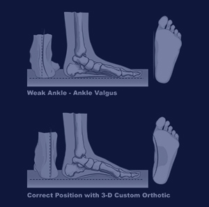 Weak Ankles